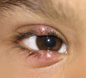 afectare vizuală secundară nistagmus oftalmologic