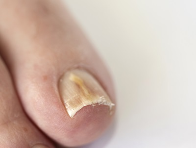 dureri articulare datorate ciupercii unghiilor luxația recuperării complete a articulației cotului