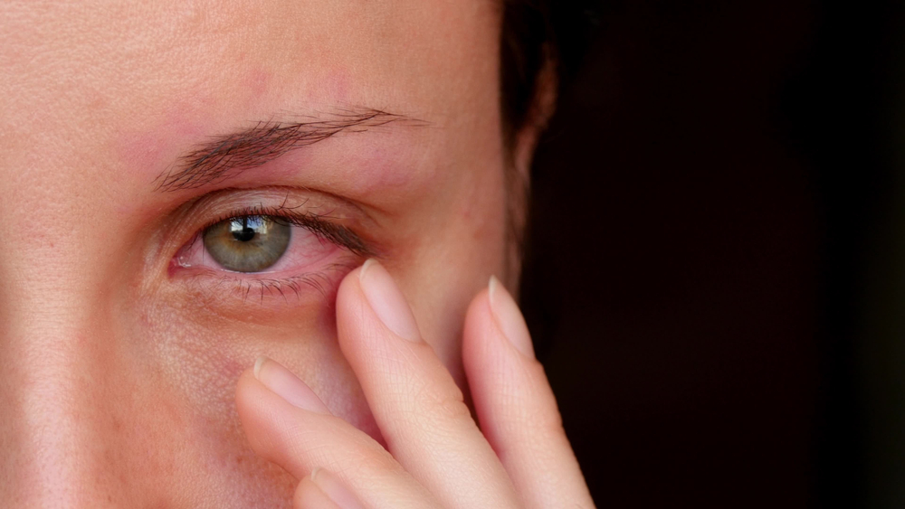 Piele iritata in jurul ochilor - Despre viața din România