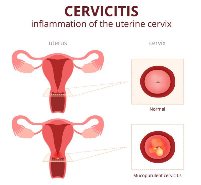 Condiloamele acuminate anale și genitale - infecția cu HPV