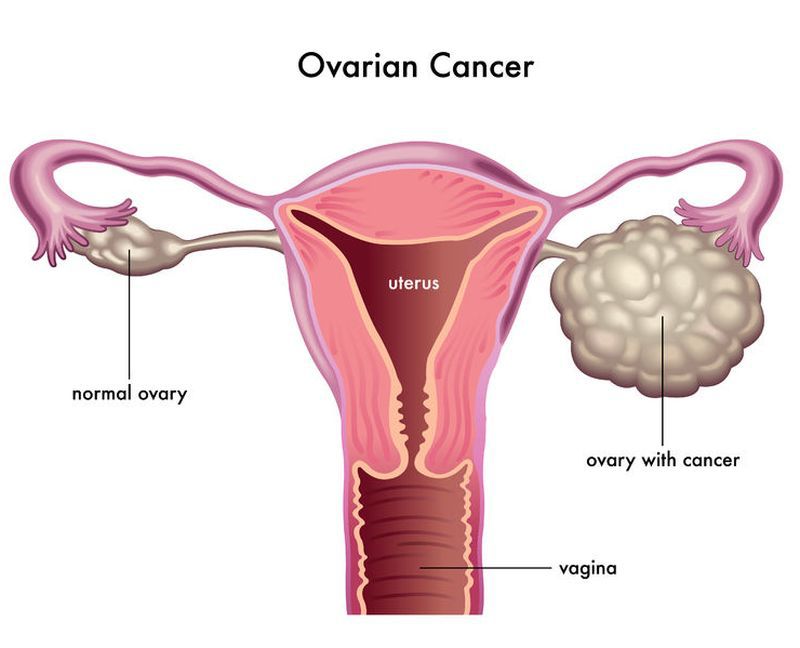 simptome cancer ovare
