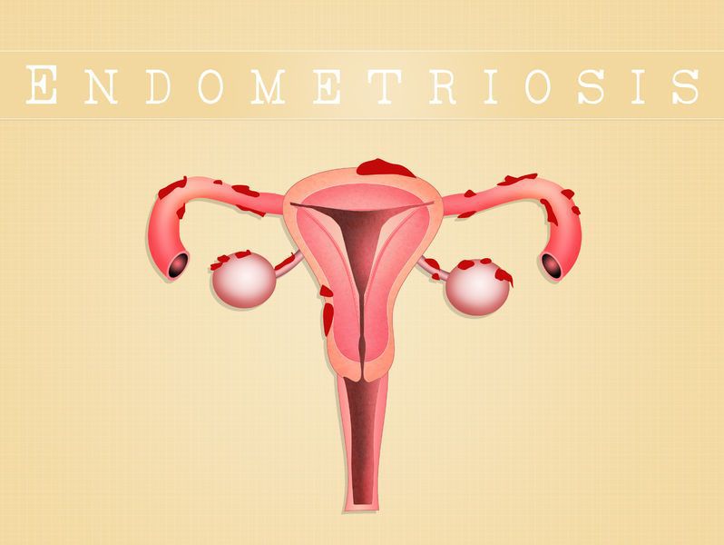 endometrioza cum să piardă în greutate)