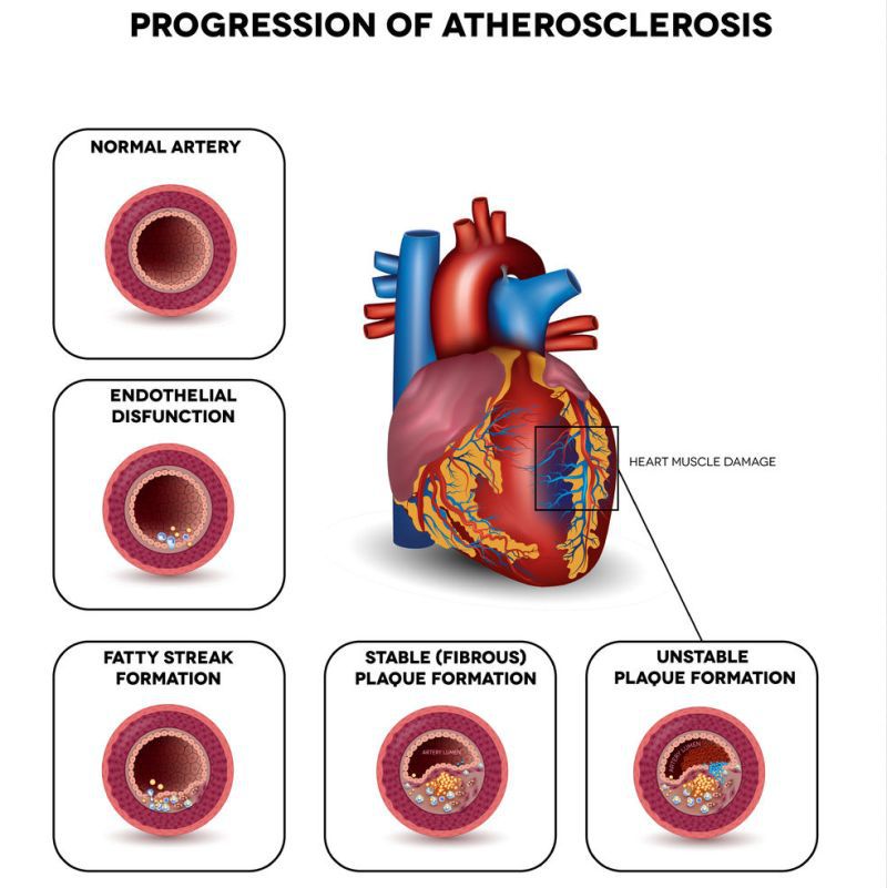 tratament articular de ateroscleroză