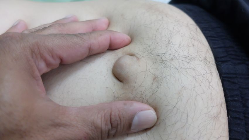 Hernia Inghinală Sau Ombilicală Simptome Tratament Complicații