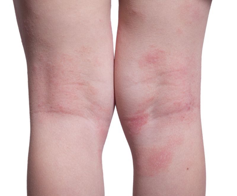 Cum să tratați mâncărimea pielii de pe picior cu vene varicoase
