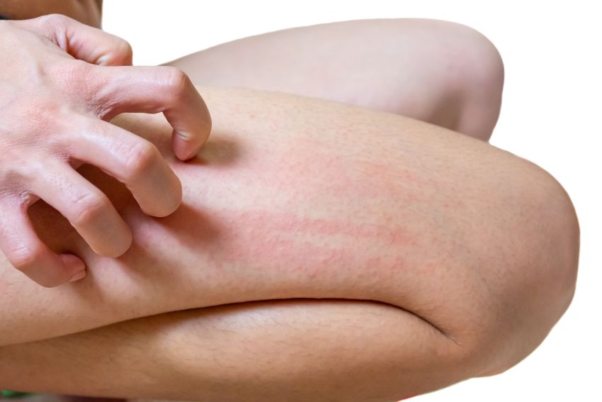 mâncarimea pielii picioarelor în varicoza