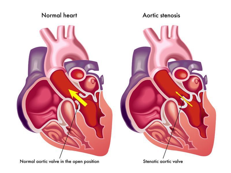 Tot ce trebuie să ştii despre stenoza aortică - CSID: Ce se întâmplă Doctore?