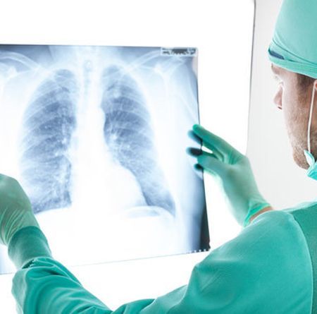 Ce trebuie să știți despre cancerul pulmonar