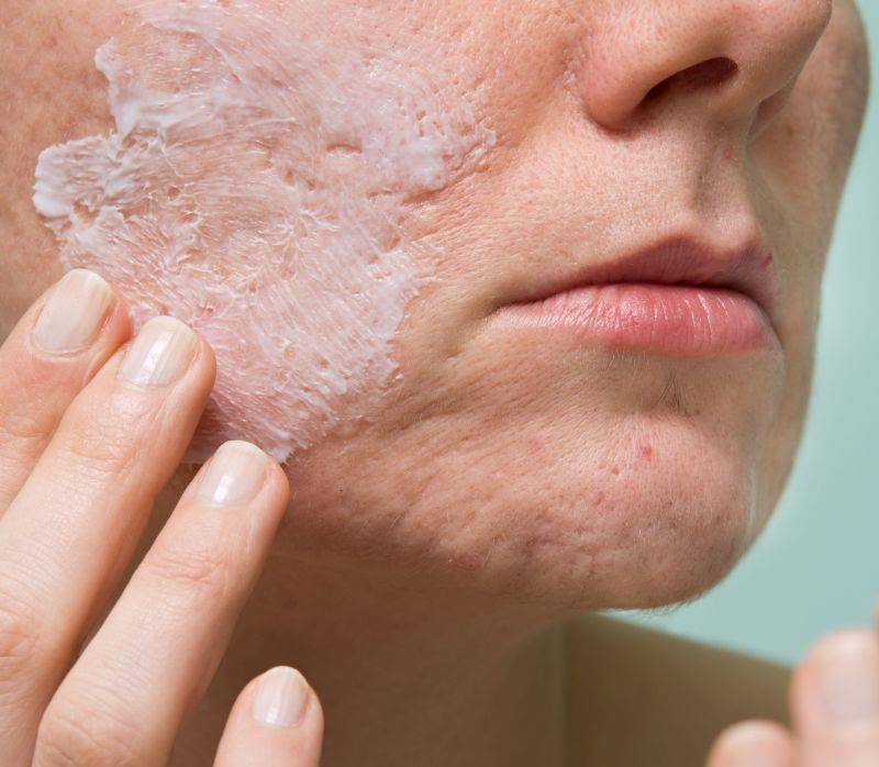 Cele mai populare tratamente naturiste pentru acnee