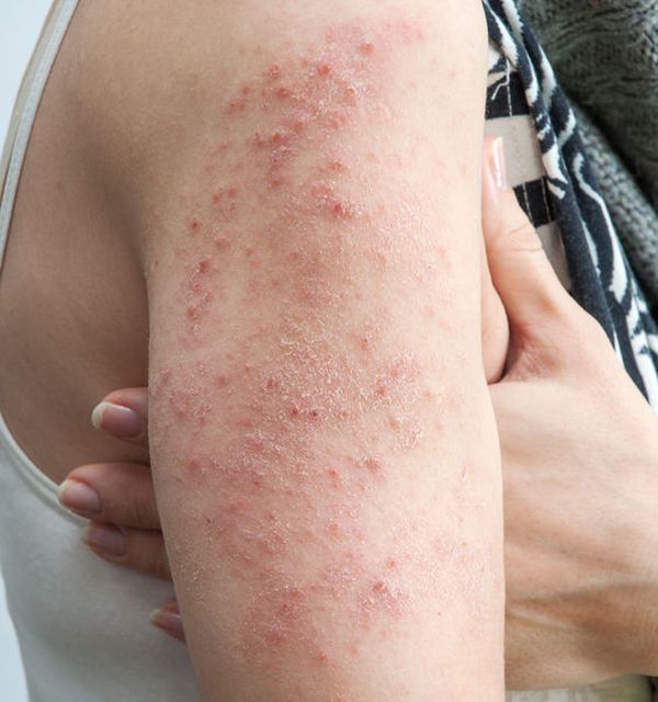 eczema pe picioare în tratamentul venelor varicoase