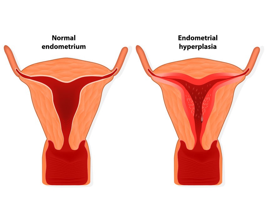 Hiperplazie de endometru. Cauze si tratament. - Dacia Medical Center