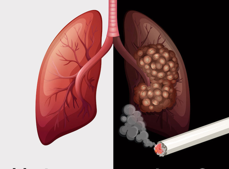 cum afecteaza fumatul varicoza