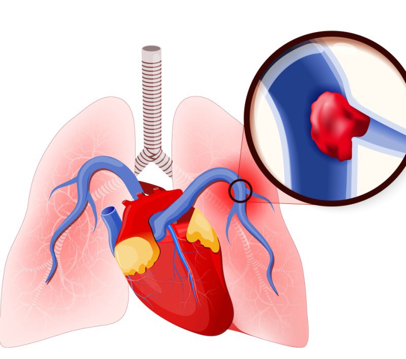 embolie pulmonara nastere