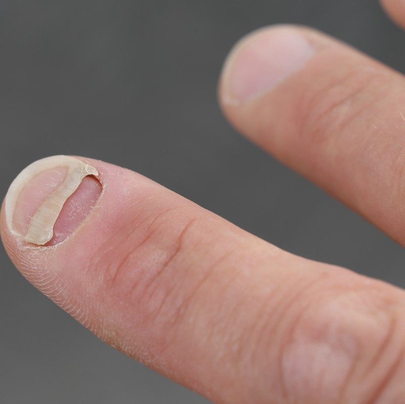 unghia se desprinde de pe piele cu ciuperca unghiei