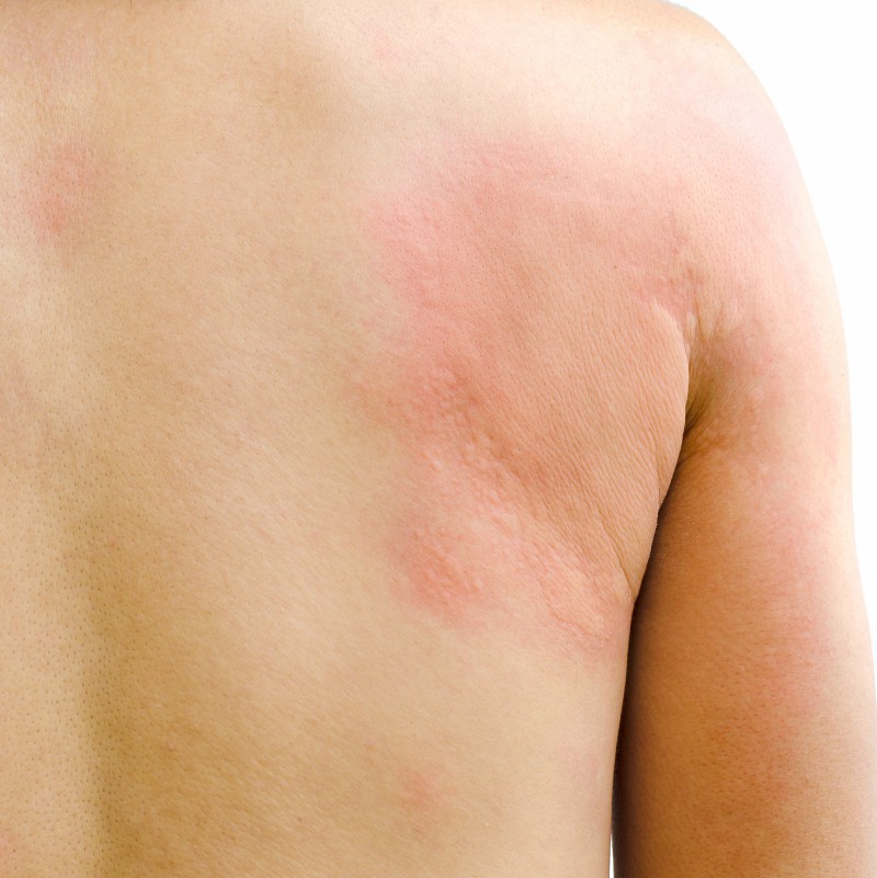 Dureri articulare alergii umflate