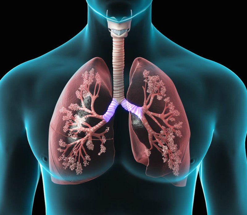 tratamentul simptomelor pulmonare cum se elimină papilomul