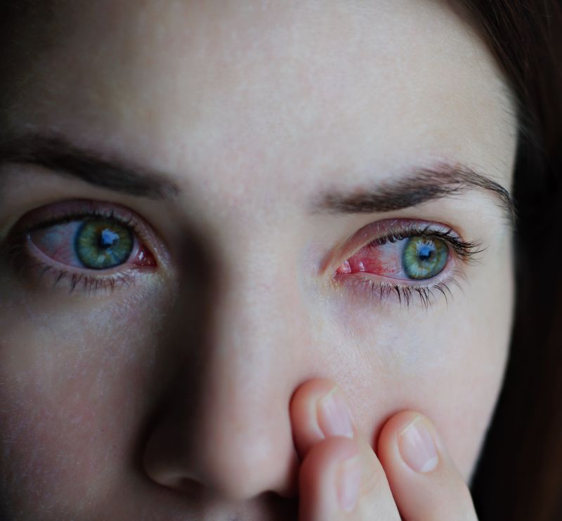 Roseata ochilor si dureri articulare AfecÈiuni ale corneei