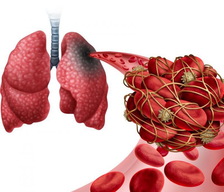 Cum îți dai seama că ai cheaguri de sânge - semne că trebuie să ajungi urgent la medic