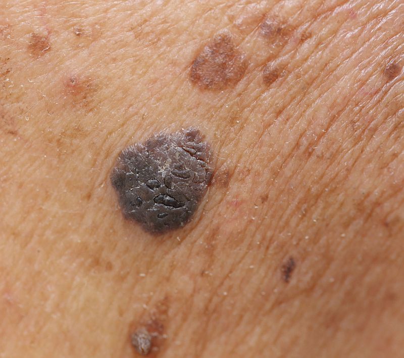 cancer malign de piele