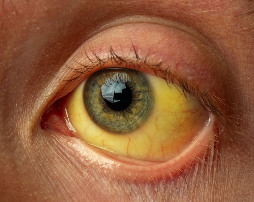 Vederea deteriorată cu ciroza ficatului. 8 lucruri care distrug ficatul - Farmacia Ta - Farmacia Ta