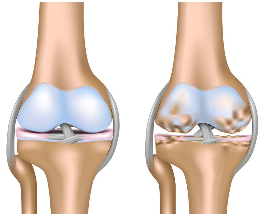 Edem trabecular - Edem trabecular al tratamentului articulațiilor genunchiului