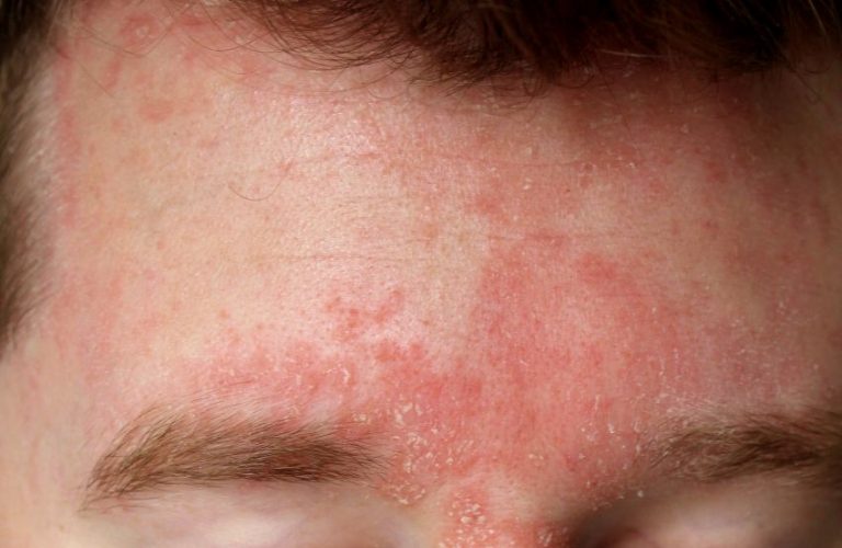 Dermatita seboreică: de ce apare, cum se manifestă, cum o tratăm? Explică dr. Cristina Țîbîrnă, medic dermatologDermatita seboreică