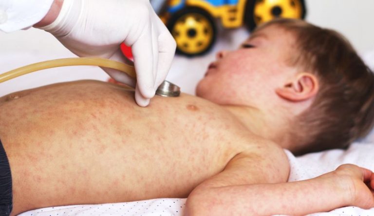 Rujeola, o boală ce poate fi prevenită prin vaccinare, a luat 200 de mii de vieți în 2019