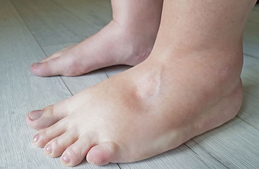 Cauze și remedii picioare umflate - straluceste in pantofi 💃