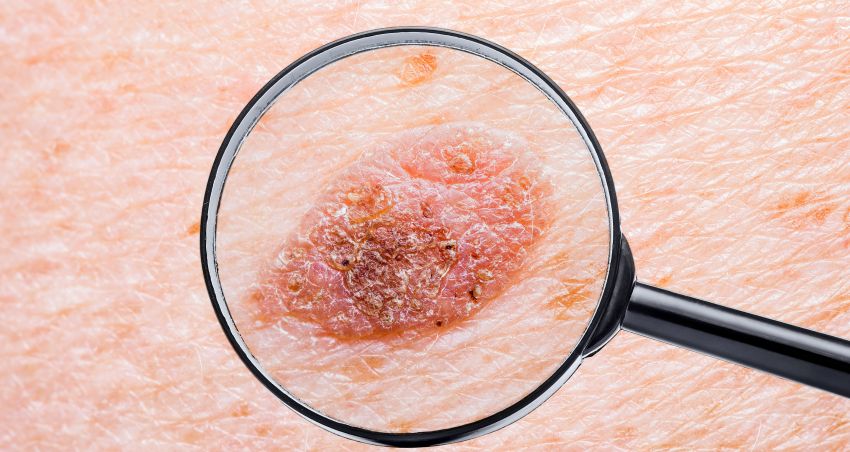 Cancerul de piele poate fi detectat cu ajutorul inteligenței artificiale