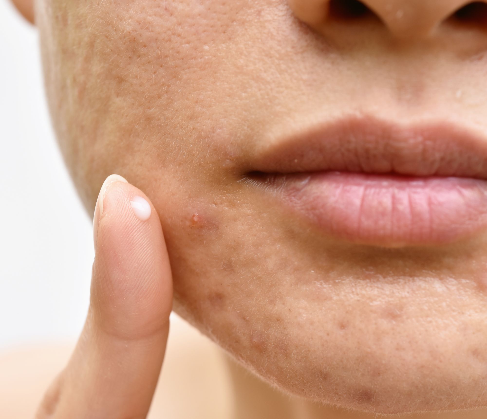 Top 6 Acne Supplements for Clear, Beautiful Skin Vitamin C, D, E, Fish