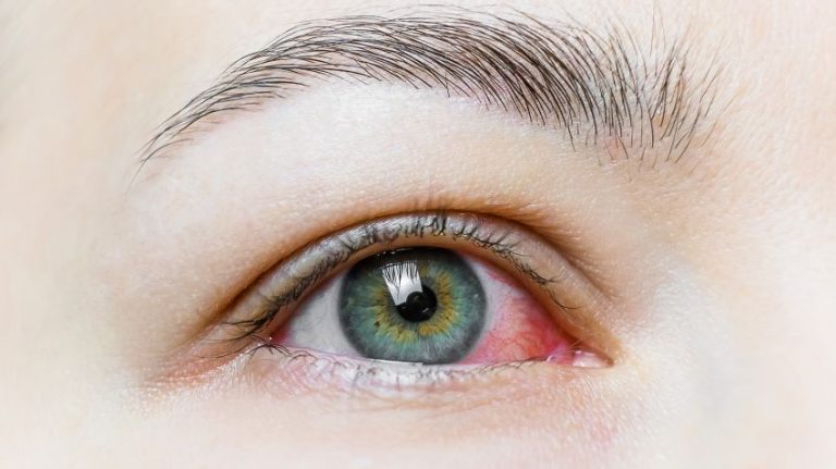 Conjunctivita virală, un posibil simptom COVID-19. Sfaturile medicului specialist