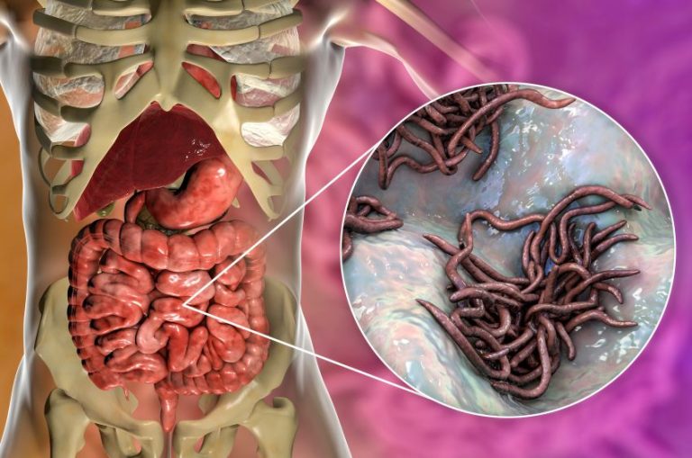 Cum îți dai seama că ai viermi intestinali. 20 de semne ale paraziților în organism