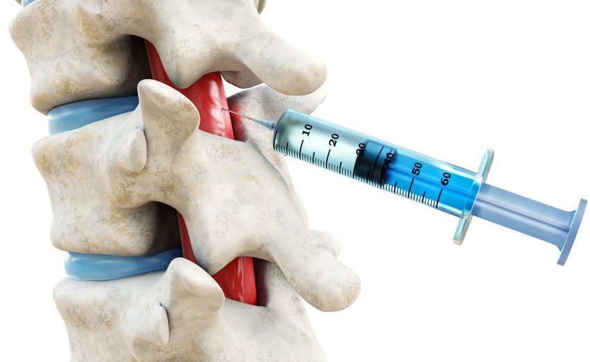 Injecțiile epidurale cu steroizi pentru durerile de spate. Când sunt