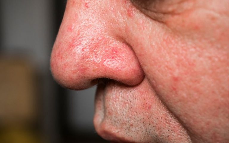 Pete roșii pe nas - acnee, cancer de piele, boli de ficat și alte cauze ale acestui simptom