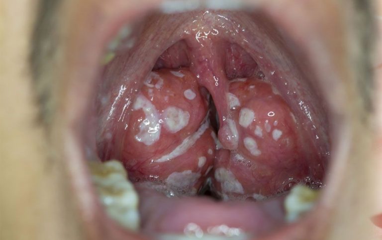 Pietrele pe amigdale: cauze, simptome, tratament naturist și proceduri medicale