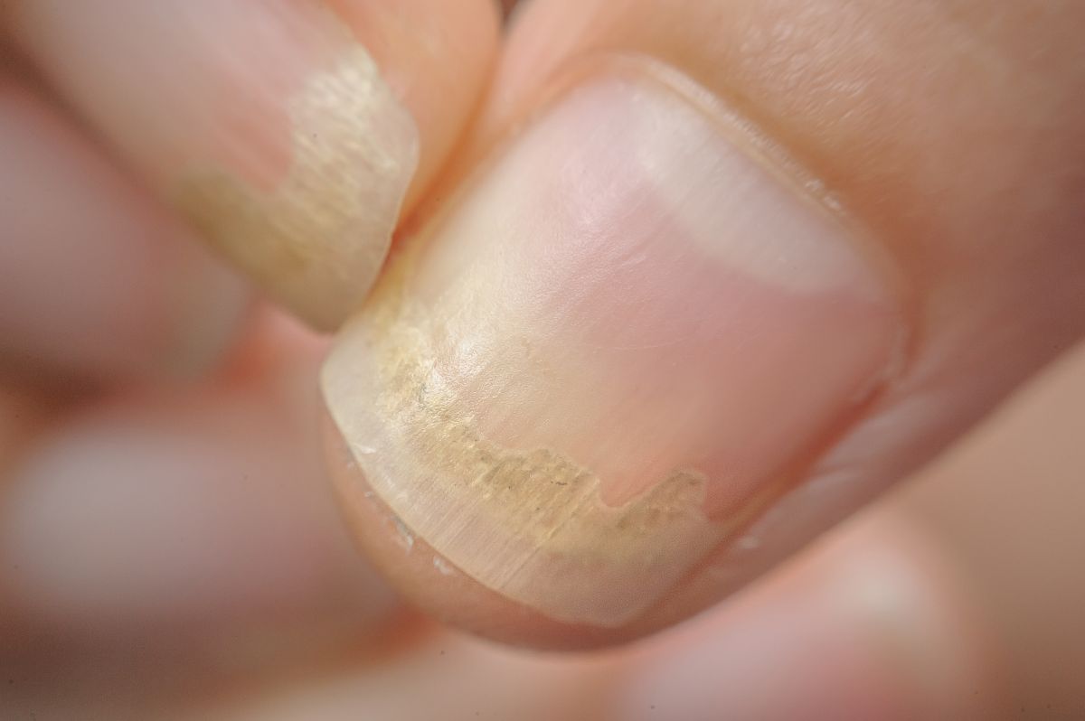 ciuperca unghiilor