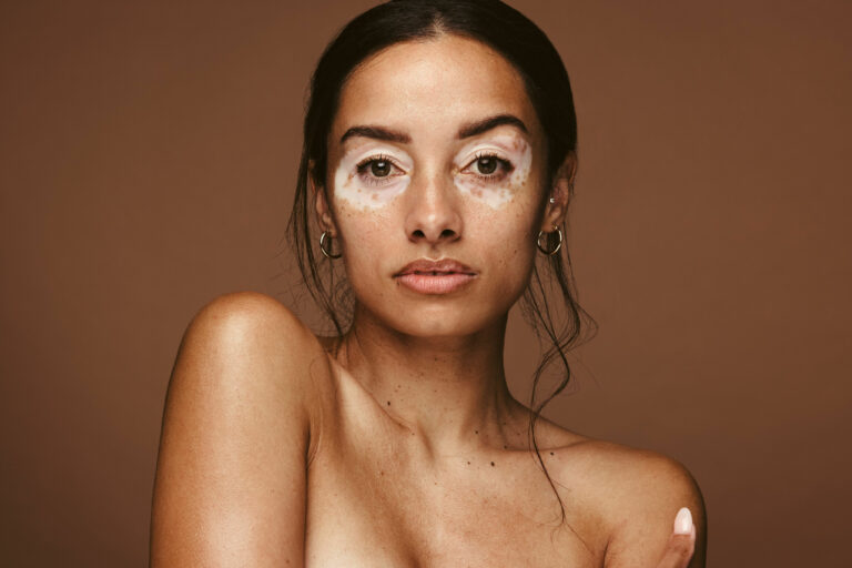 vitiligo, foto Shutterstock