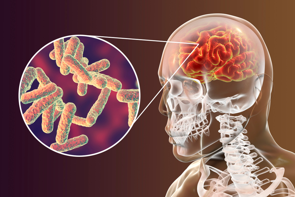 Meningita bacteriană: efecte, riscuri, simptome