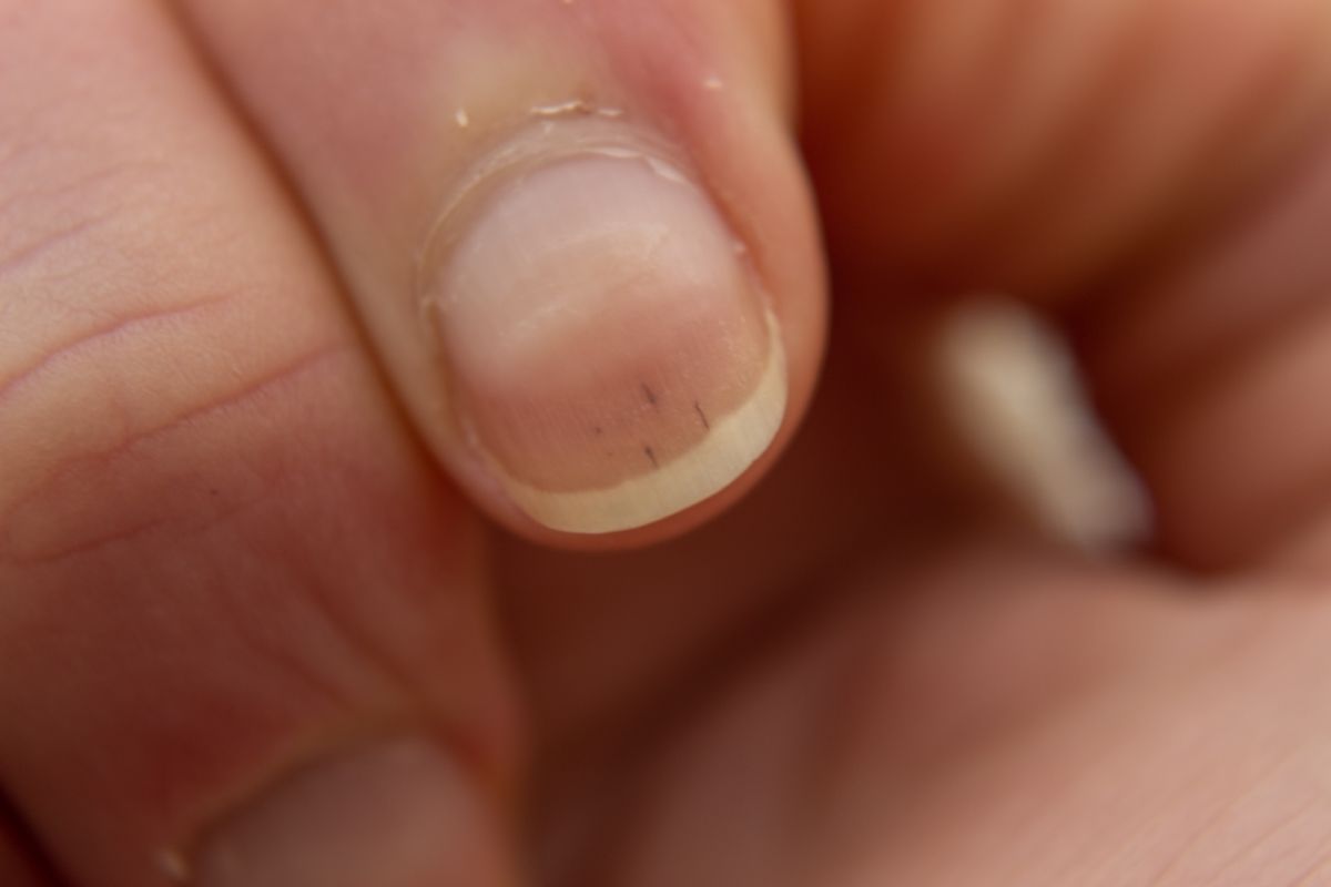 Nail Changes in Kidney Disease Symptoms, Causes, and Remedies World