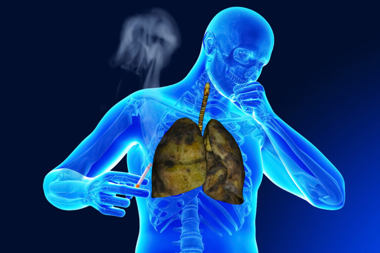 Primele semne de cancer pulmonar