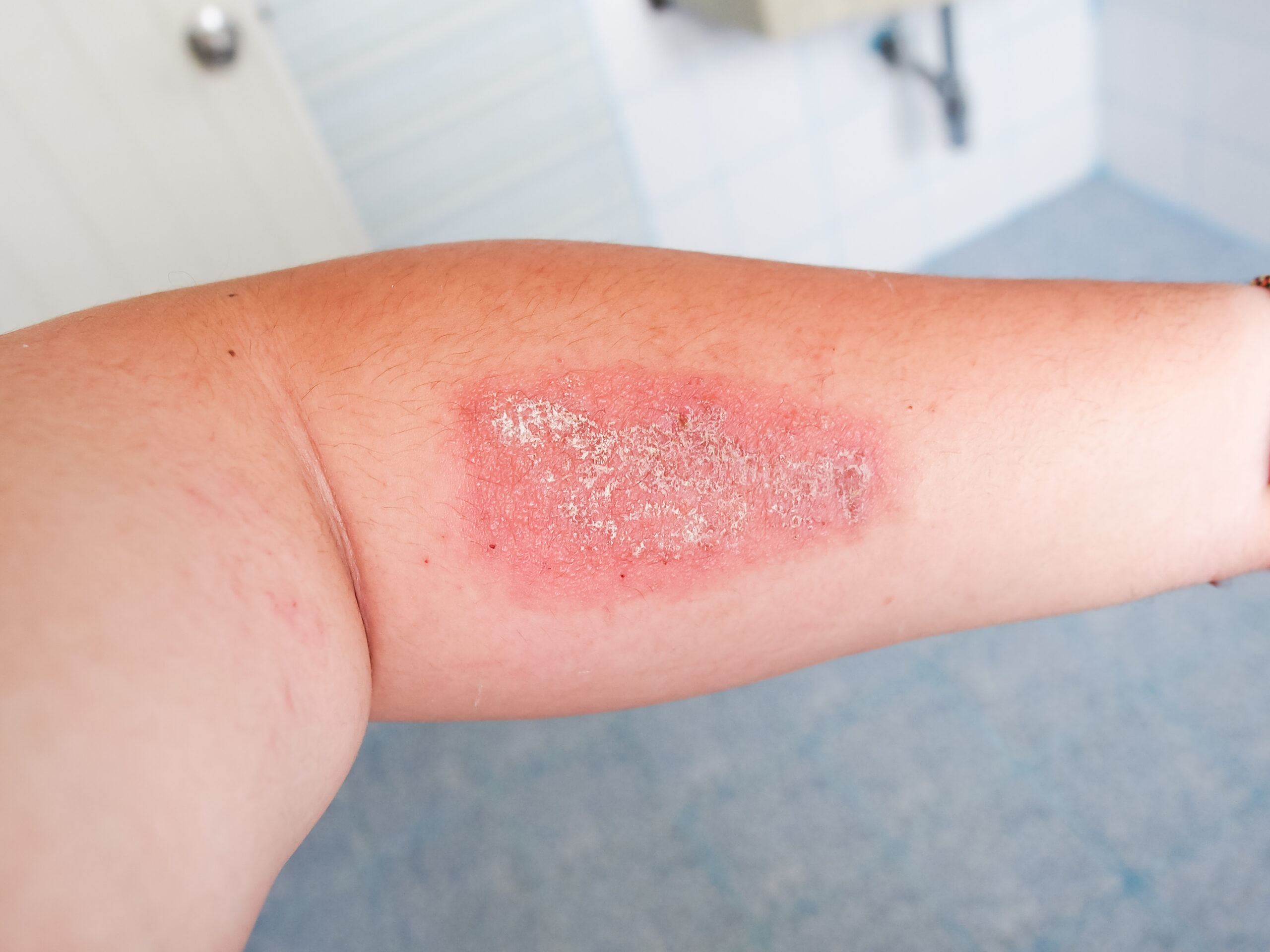 Title Understanding Staphylococcus Aureus Infection Transmission