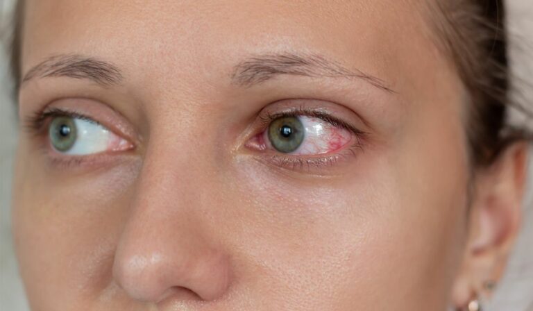 Medicii au crezut că are o eczemă, dar o tânără a aflat singură că suferă de o boală rară: „Am insistat că nu e adevărat!”