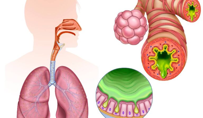 Inflamația cronică: „dușmanul invizibil” al sănătății moderne