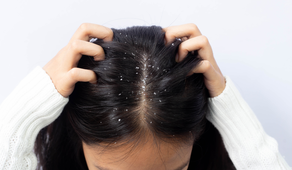 Cum poți scăpa de mătreață în mod natural. Obiceiurile care pot reduce exfolierea scalpului și preveni reapariția ei