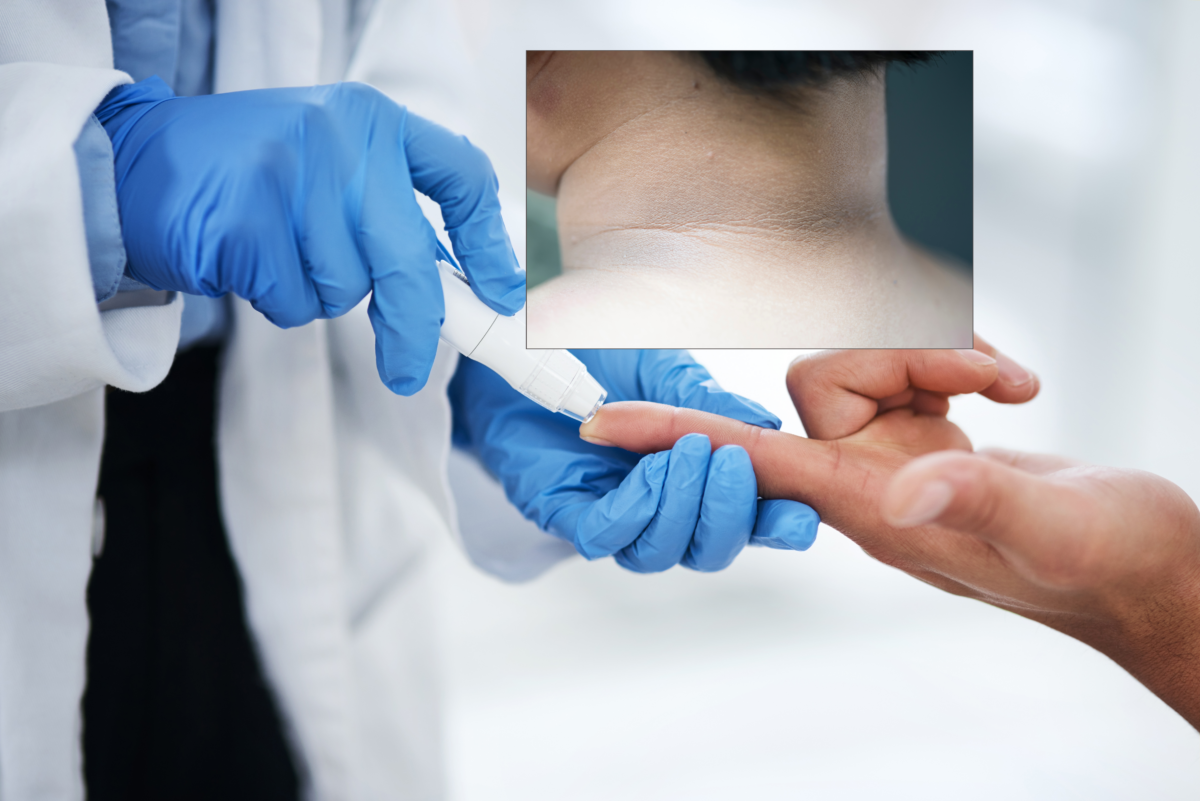Medicii avertizează: o pată închisă la culoare pe piele poate fi un semn al diabetului de tip 2