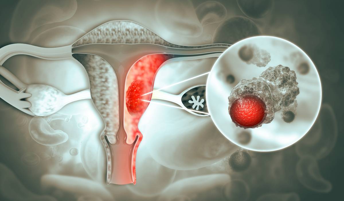 Peste 40% dintre femeile cu cancer ovarian află diagnosticul abia după o urgență medicală. Simptome pe care nu trebuie să le ignori, de la balonare persistentă, la urinări frecvente