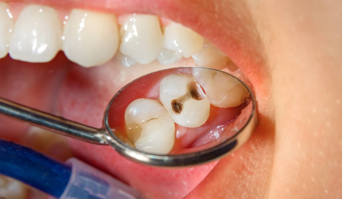 Știai că există mai multe tipuri de carii dentare și că cele negre nu sunt cele mai periculoase?