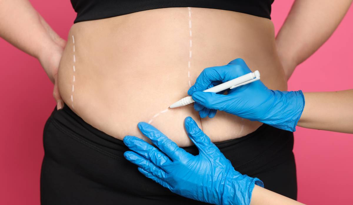 Prima vară după chirurgia bariatrică: cum îți schimbi corpul, dar și relația cu tine însuți