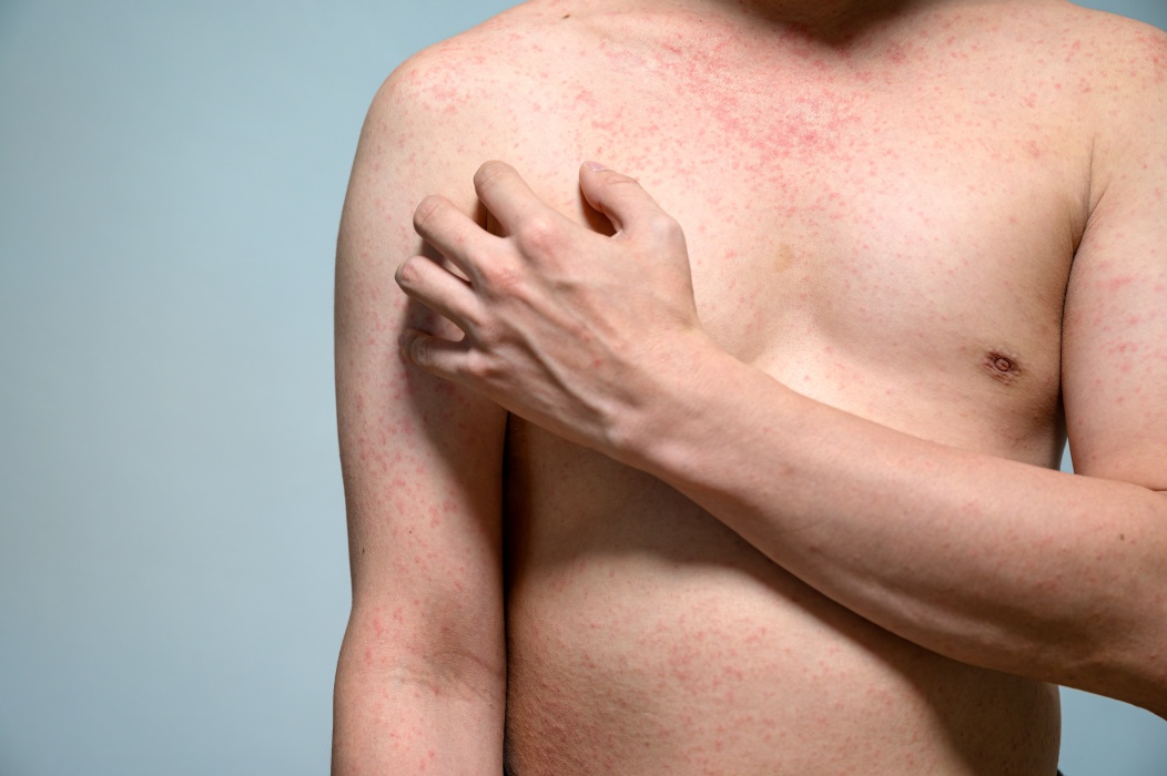Dermatita atopică nu înseamnă doar piele uscată. Simptomul care poate afecta serios viața de zi cu zi