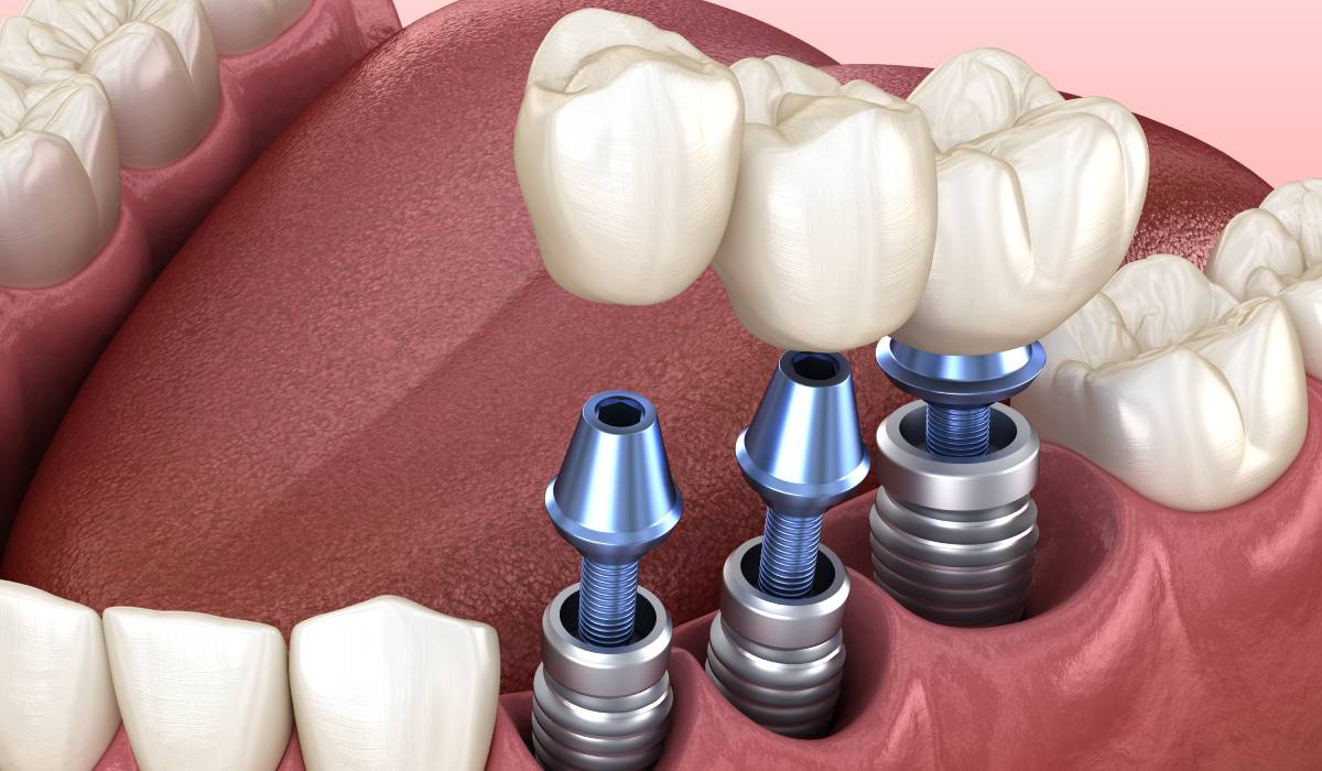 Dinți ficși în 24 de ore: mit sau realitate? Tot ce trebuie să știi dacă te-ai hotărât să-ți pui un implant dentar
